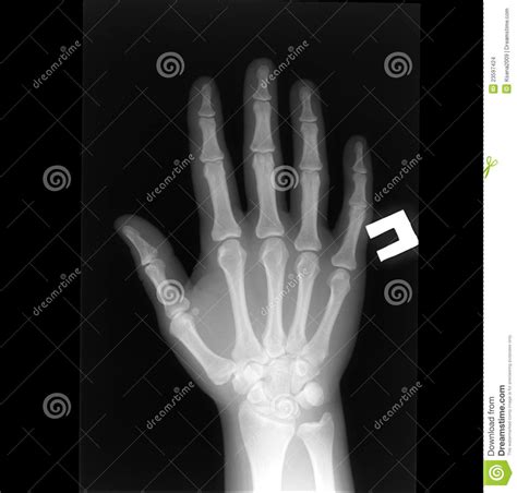 X Ray Of Human Hand Stock Photo Image Of Fingers Death