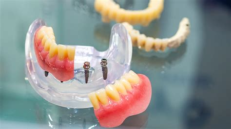 Mini Dental Implants Procedure Advantages Disadvantages