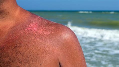 How To Get Rid Of A Sunburn Fast Cool Off Aloe And Moisturize