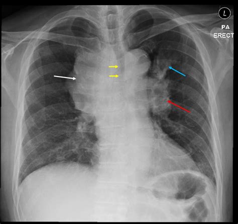 Mediastinal Lymphadenopathies Lung Adenocarcinoma Radiology Cases
