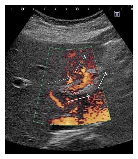 Doppler Ultrasonography Of The Portal And Hepatic Veins After Months