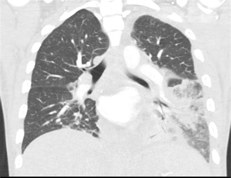 289lu Bronchopneumonia Lungs