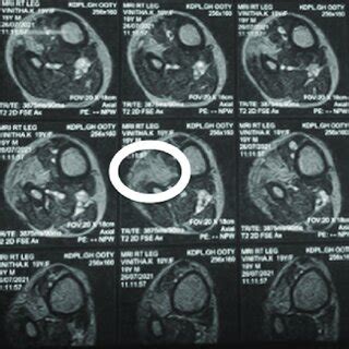 Magnetic Resonance Imaging Of The Right Lower Leg Showing Homogeneous