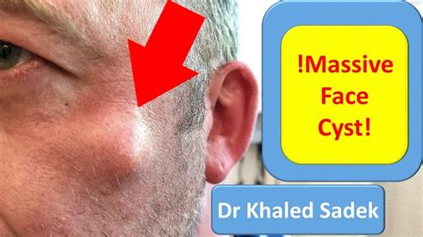 5 Year Face Cyst Cyst Removal Clinic London Dr Khaled Sadek Pimple