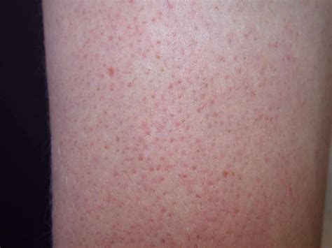 Real Life Experience Can Wheat Intolerance Cause Skin Rash