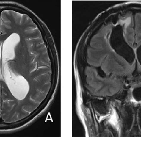 A Magnetic Resonance Image T2 Wighted Image Shows Enlarged Of Lateral