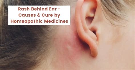 Rash Behind Ear Causes And Treatment By Homeopathy Medicines