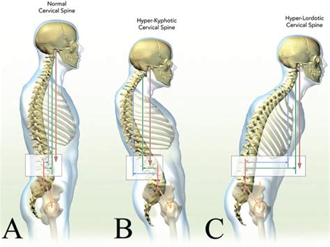 Cervical Spine Alignment Sagittal Deformity And Clinical Implications
