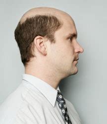 As a last resort, hair transplants are a surgical alternative that moves hair follicles from one part of your scalp to the thinning area. How To Solve Hair Loss In Young Men Problem: Cause and ...