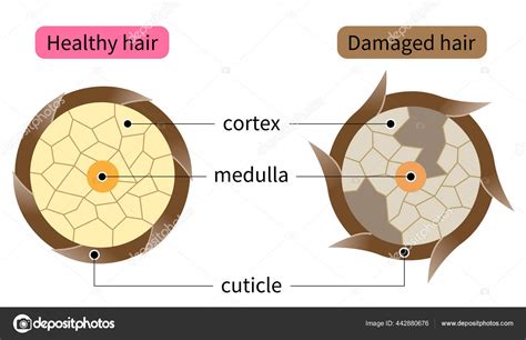 Layer Healthy Damaged Hair Structure Hair Shaft Consists Cortex Cuticle