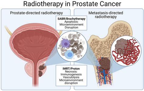 Radiation Therapy In Oligometastatic Prostate Cancer International Journal Of Radiation