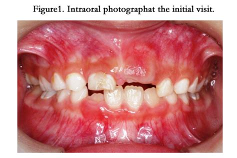 Central Odontogenic Fibroma Associated With Eruption Disturbance Of A