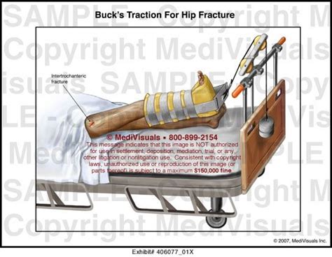 Sign in to add to cart. BUCKS TRACTION | NUR 255 | Pinterest | Nclex
