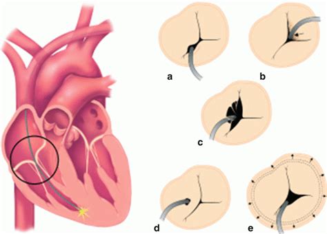 Tricuspid Regurgitation In Patients With Pacemakers And Implantable