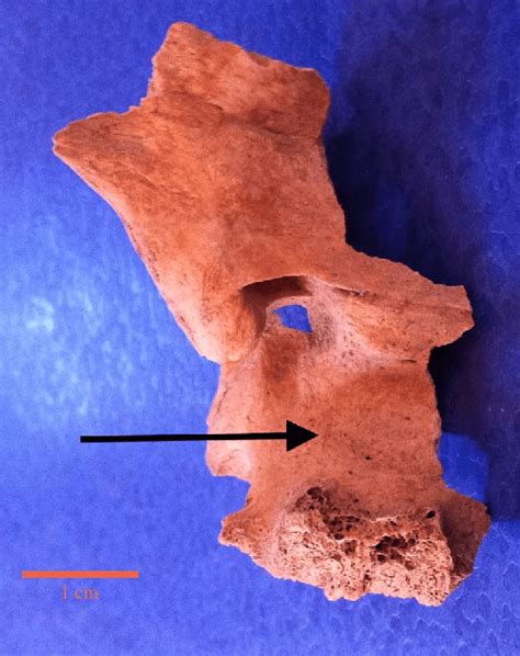 General View Of The Conserved Sphenoid Bone In Anatomical Position