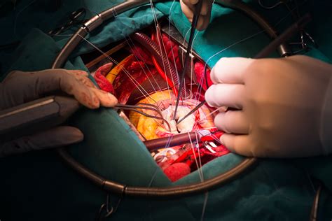 Sts Data Mitral Valve Cases Are Fastest Growing Cv Surgical