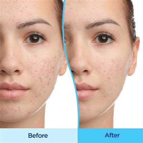 17 Best Acne Scar Treatments Of 2023 According To Dermatologists