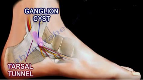 Ganglion cysts, also known as bible cysts or bible bumps, are small they usually form over a joint or tendon in the fingers, wrists, ankles or soles of the feet. Dr. Nabil Ebraheim's Blogspot: Ganglion Cyst of the Foot ...