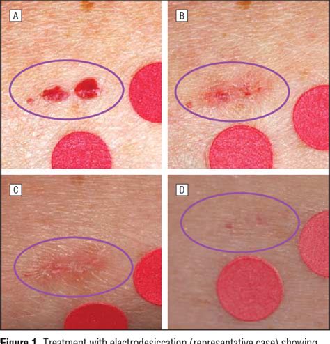 Figure 1 From Comparison Of Treatment Of Cherry Angiomata With Pulsed