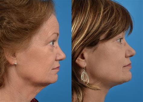 Patient 122406518 Profile Neck Lift Before And After Photos Clevens