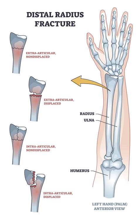 Different Types Of Distal Radius Fractures Seen In The Hand Therapy
