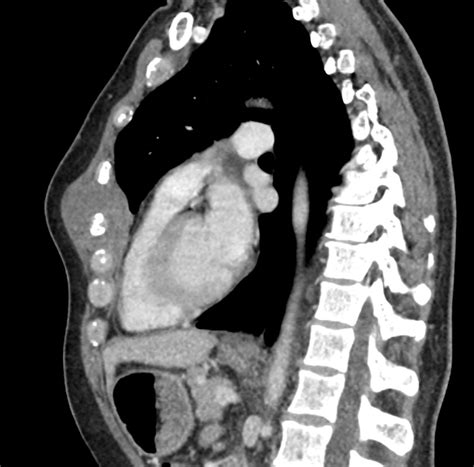 Sagittal Ct Image Of The Left Chest Wall Lesion Which Was Later Biopsy