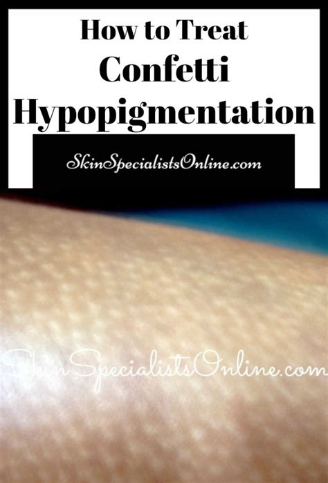Confetti Hypopigmentation Skin Specialists Online
