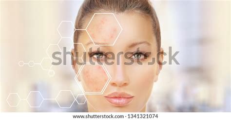 Postacne Marks Treating Acne Scars Stock Photo 1341321074 Shutterstock