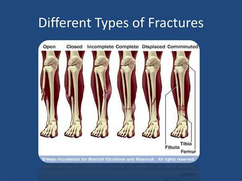 Ppt Principles Of Fractures Fracture Management Powerpoint The Best