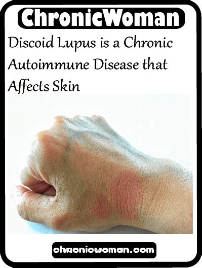 Discoid Lupus Is A Chronic Autoimmune Disease That Affects Skin Lupus