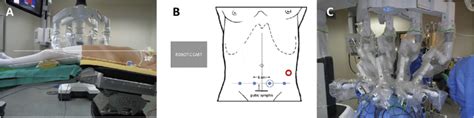 A Patient Position B Trocar Position Blue Circles Robotic Mm Download Scientific Diagram