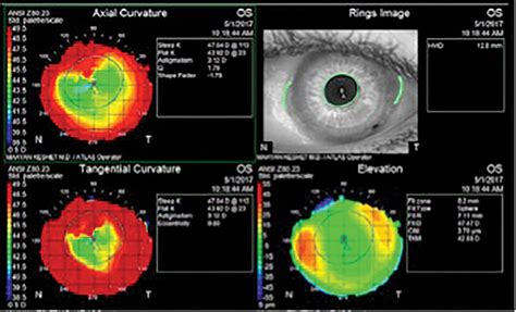 Fitting The Keratoconic Eye Post Surgery