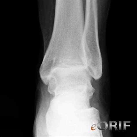 Ankle Dislocation S9306xa 8370 Eorif