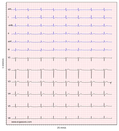 Sinus Bradycardia Definitions Ecg Causes And Management Ecg And Echo
