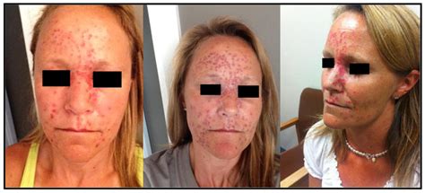 Hsv 2 formulation 2 administered concomitantly with 0.9% sodium chloride in the opposite arm at month 0 and month 2. Facial Herpes Simplex Virus Type 1 Infection in a Patient ...