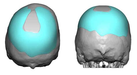 Custom Skull Implant For Skull Asymmetry Implant Design Back View Dr