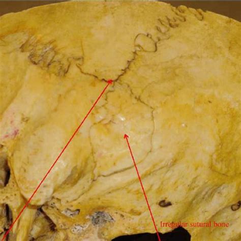 Comparative Representation Of Asterion In Different Population Of The