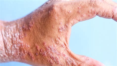 Dermatitis At Pica Un Problema De Salud Que Afecta M S All De La Piel
