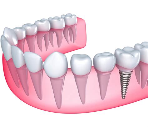 Dental Implants Procedure Houston Permanent Tooth Replacement