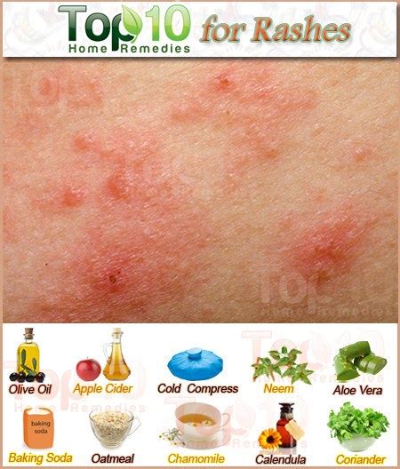 Picture 30 Of Home Remedies For Heat Rash On Face A Rcane Soul