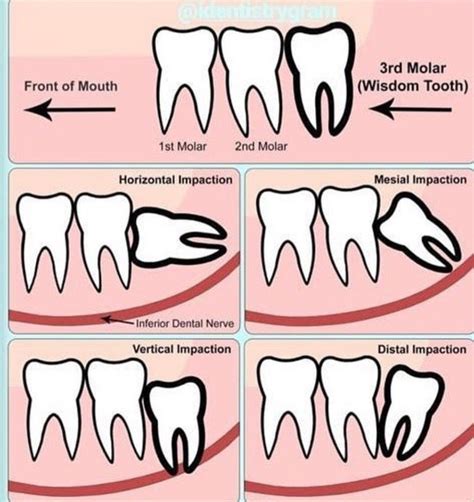 Wisdom Tooth Impaction Dental Hygienist Dental Clinic Dental