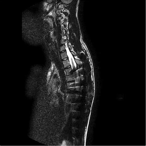T2 Weighted Sagittal Mri Images Of The Cervical And Thoracic Spine Due