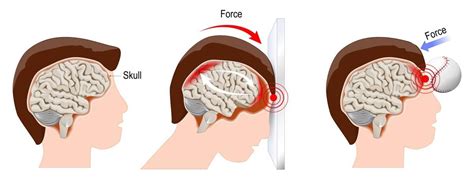 Head Injury And Audiology Ent Blog