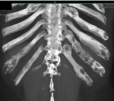 Fibrous Dysplasia Involves Ribs And The Spine Case Study