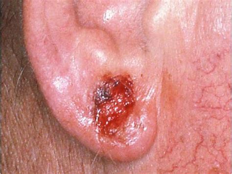 Squamous Cell Carcinoma On The Ear Skin Cancer Or Mole How To Tell