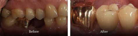 Dental Implants Neutral Bay Shore Dental