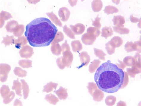 Monoblasts In Peripheral Blood