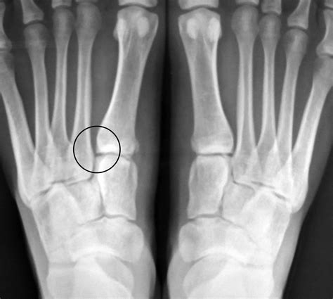 Subtle Lisfranc Subluxation Results Of Operative And Nonoperative