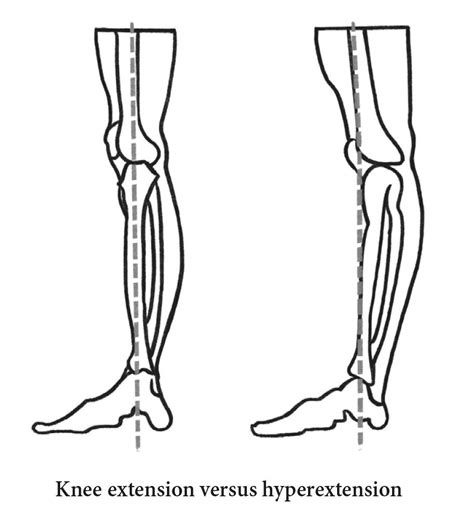 What Is Knee Hyperextension Doctor Yogi