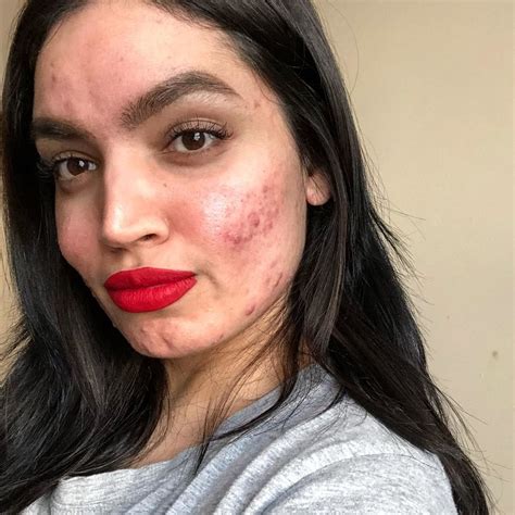 Acne Positive Blogger Kadeeja Khan Was Dropped From A Loréal Campaign